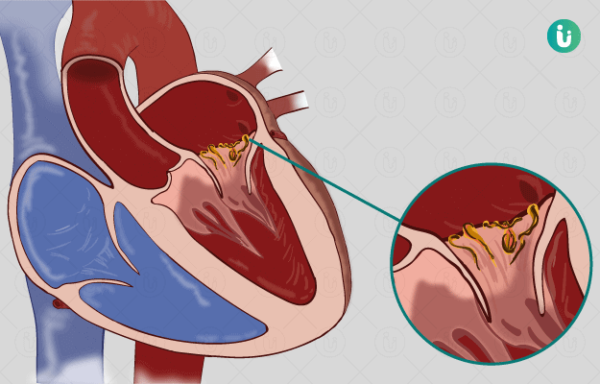 Bacterial Endocarditis Dermatology Conditions And Treatments