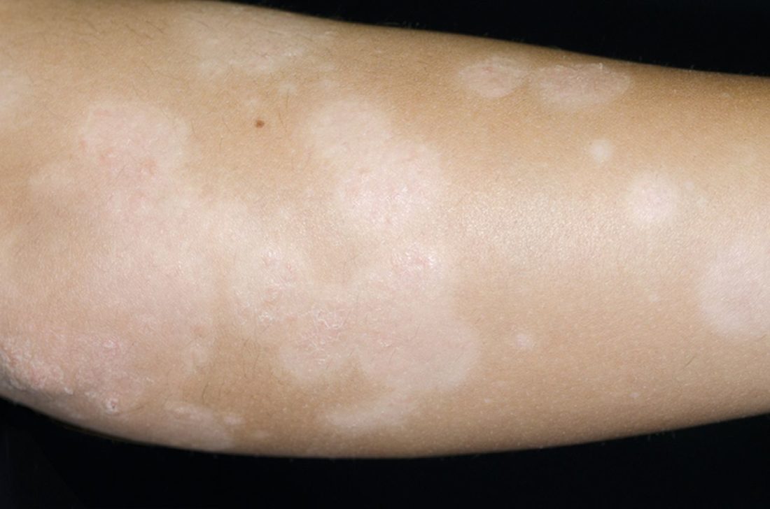 Hypopigmentation Dermatology Conditions And Treatments