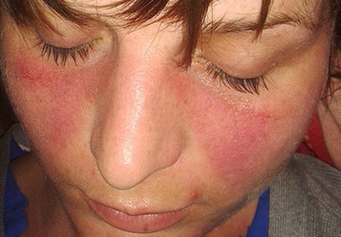 LUPUS – Dermatology Conditions and Treatments