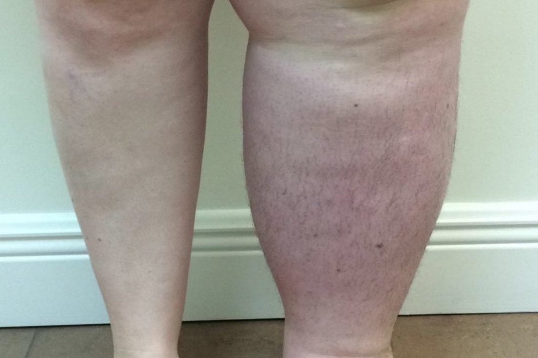 lymphedema-dermatology-conditions-and-treatments