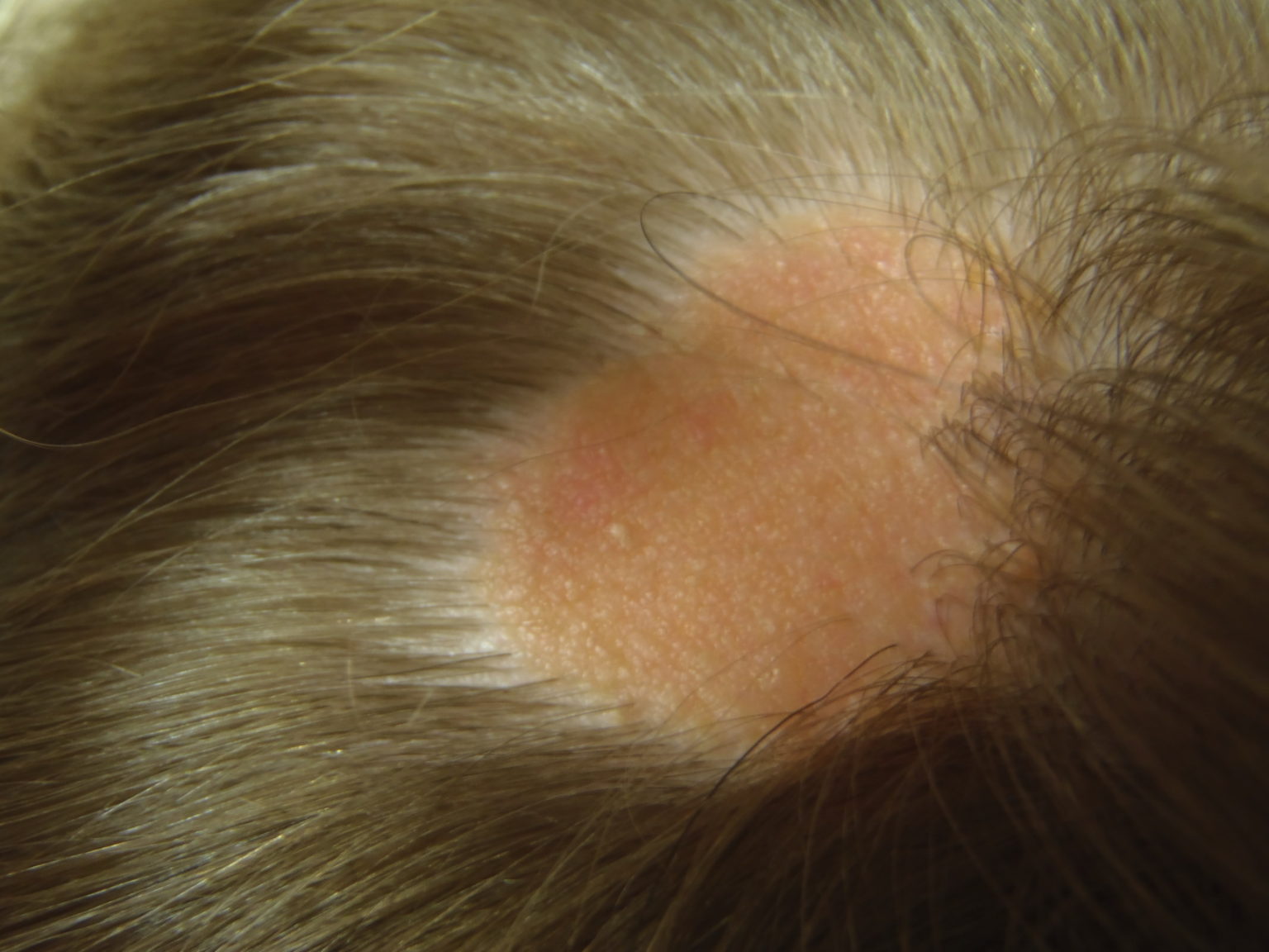 NEVUS SEBACEOUS Dermatology Conditions and Treatments