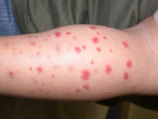 PURPURA – Dermatology Conditions and Treatments