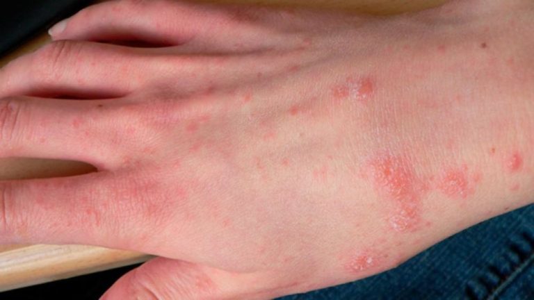 scabies-meaning-treatment-and-symptoms