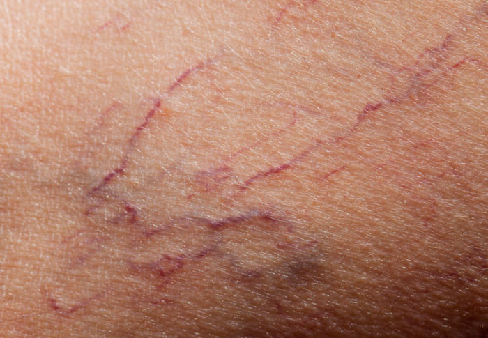 SPIDER VEINS – Dermatology Conditions and Treatments