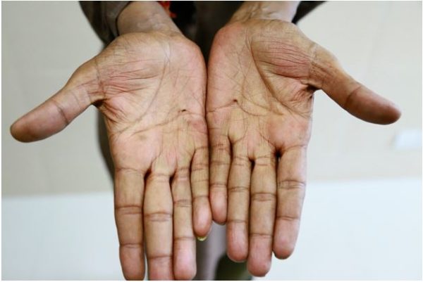 stigmata-dermatology-conditions-and-treatments