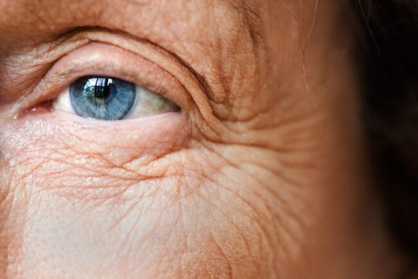 WRINKLES – Dermatology Conditions and Treatments