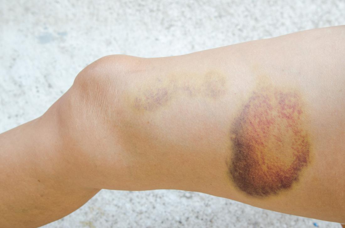 A Hematoma Usually Forms At A Fracture Site